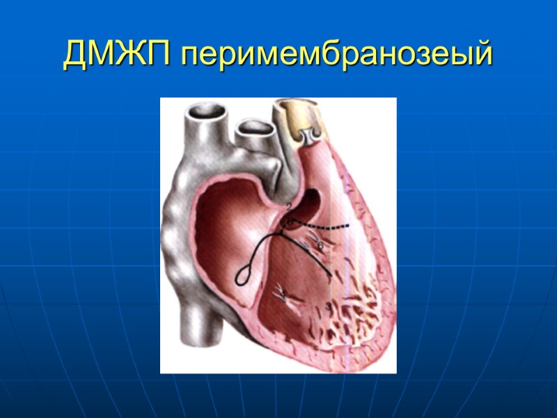 ДМЖП перимембранозеый